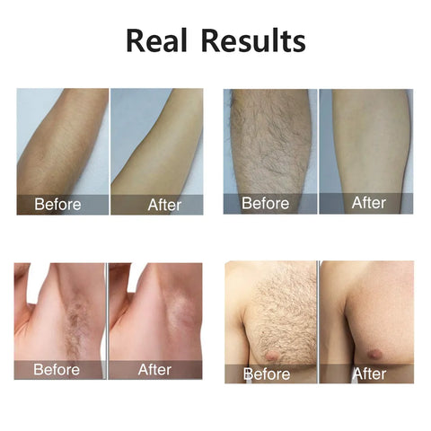 Hailicare IPL Laser Hair Removal - Pulse of Strong Light with Effective Results